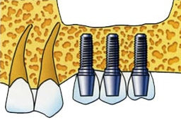 3 Schraubimplantate mit Zahnersatz bestückt