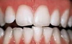 Zähne nach einem Bleaching